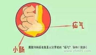 成人疝气根治方法视频,成人疝气根治方法深度解析